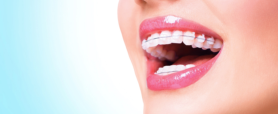 Make your smile brighter using a teeth whitening procedure